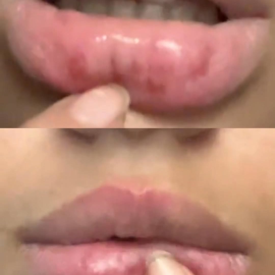 CA - Belani Fordyce Seeds - Lip Lightening Cream for Dark Lips, Lip Scrubber & Fordyce Spots, Chapped or Pigmented Lips, Moisturizing Lip Care Balm  – 20ml