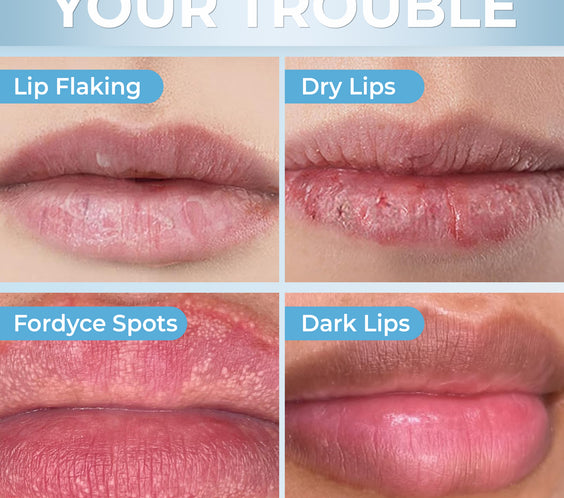 CA - Belani Fordyce Seeds - Lip Lightening Cream for Dark Lips, Lip Scrubber & Fordyce Spots, Chapped or Pigmented Lips, Moisturizing Lip Care Balm  – 20ml