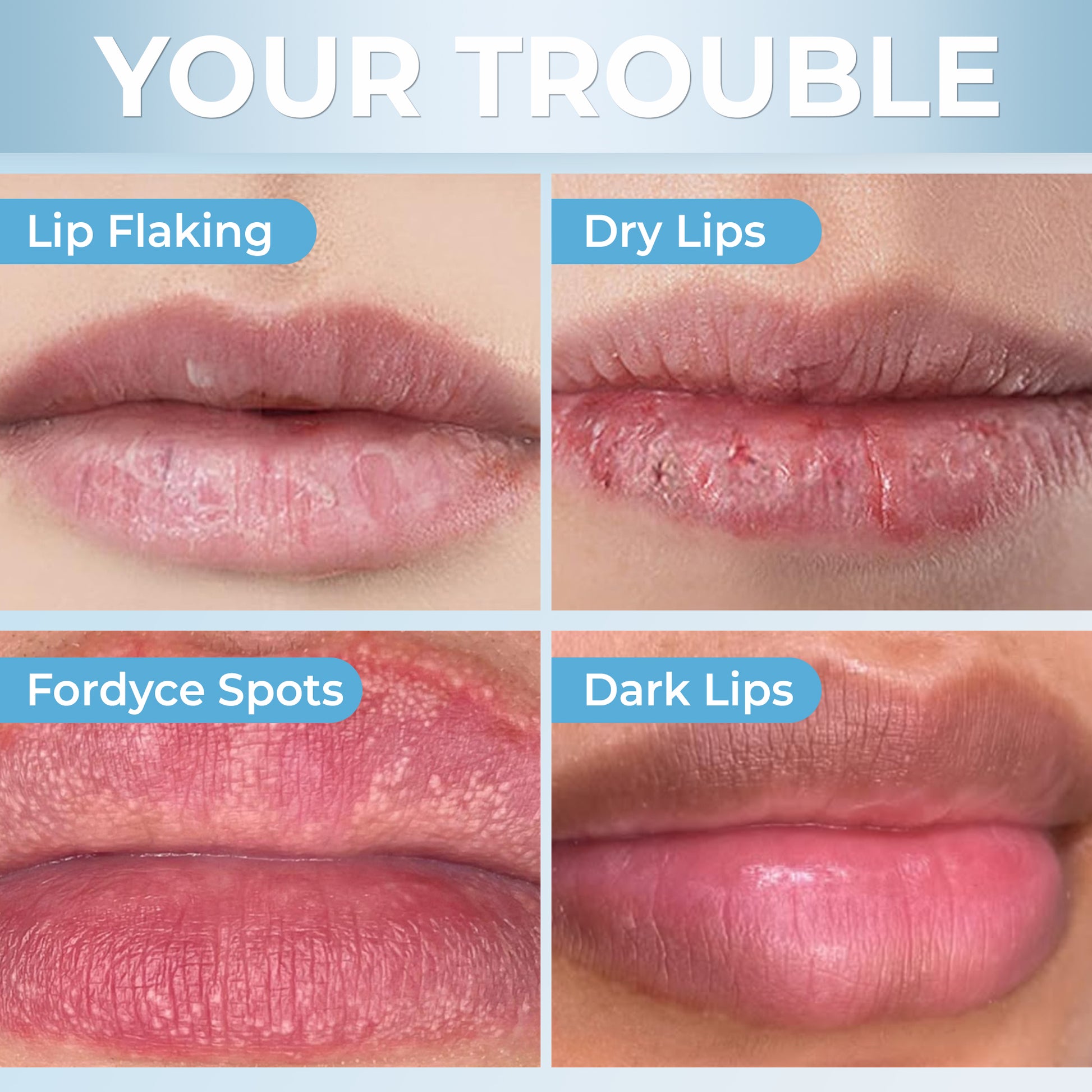 CA - Belani Fordyce Seeds - Lip Lightening Cream for Dark Lips, Lip Scrubber & Fordyce Spots, Chapped or Pigmented Lips, Moisturizing Lip Care Balm  – 20ml
