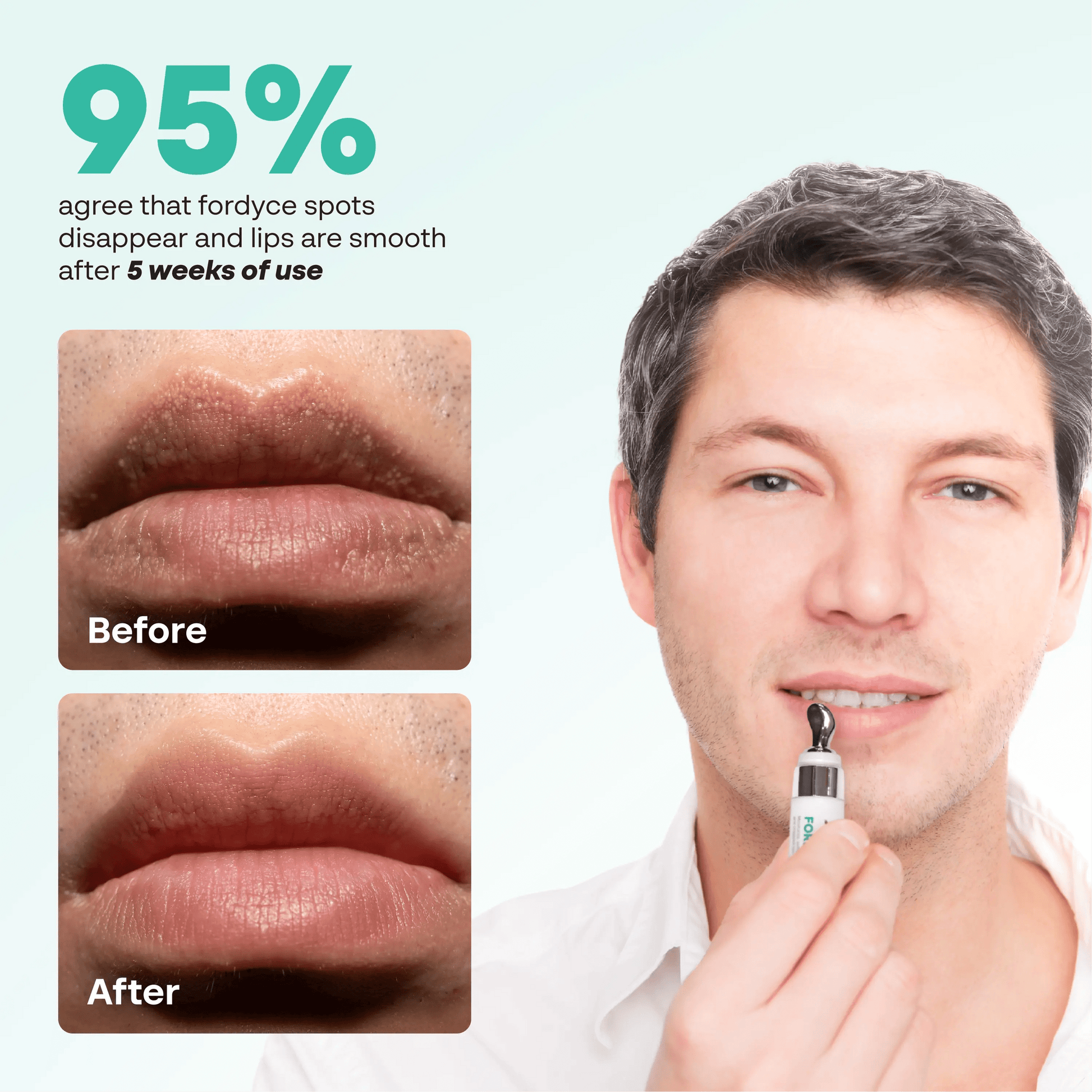 Crème Abera Fordyce – Formule avancée au HPR (rétinoïdes nouvelle génération), pour l'acné des lèvres, les lèvres sèches et gercées (20 g)